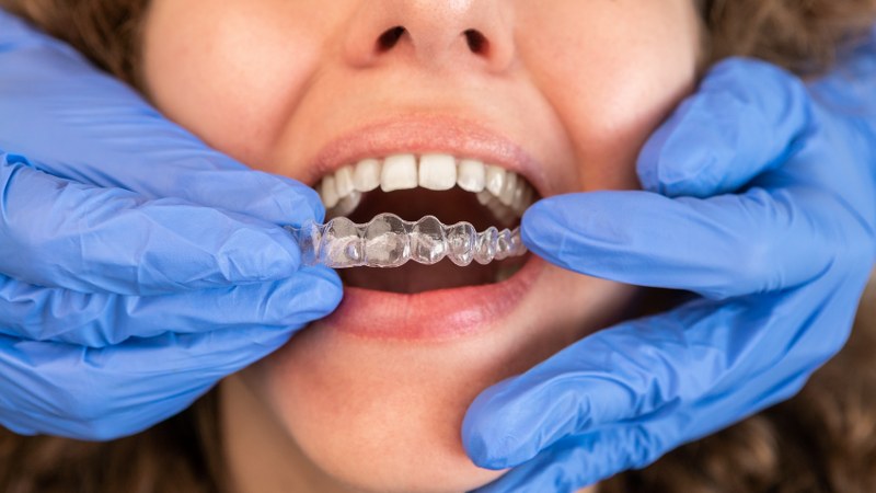 Invisalign (Braceless) Orthodontics